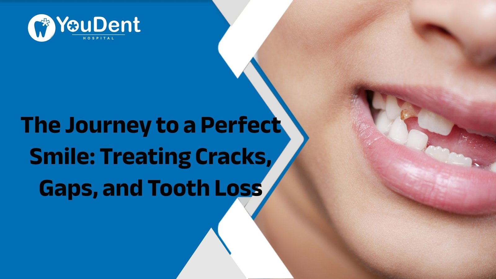 The Journey to a Perfect Smile: Treating Cracks